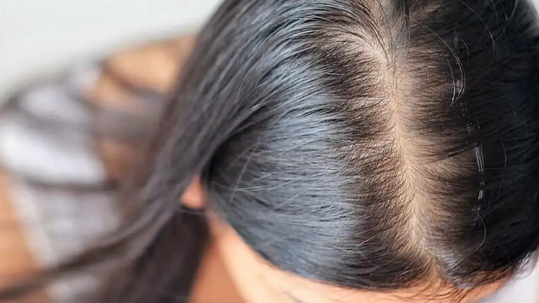 Corona virüsü atlatanları ilgilendiriyor: 6 ayda kelliğe neden olabilir!