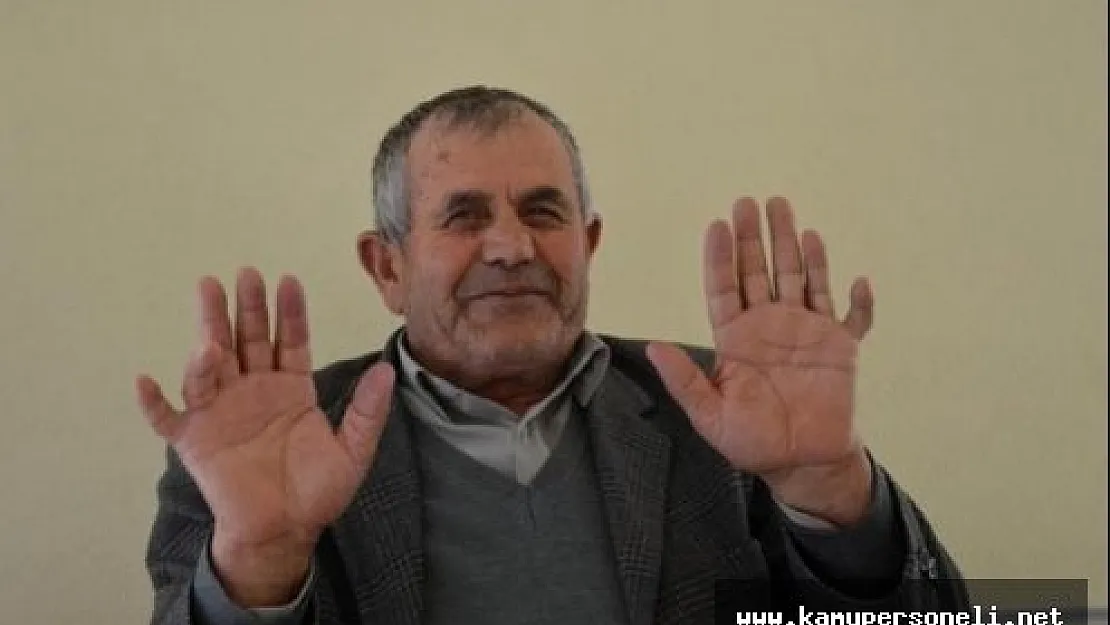 24 Parmağı Olan Ali İhsan Özdemir Görenleri Şaşırtıyor