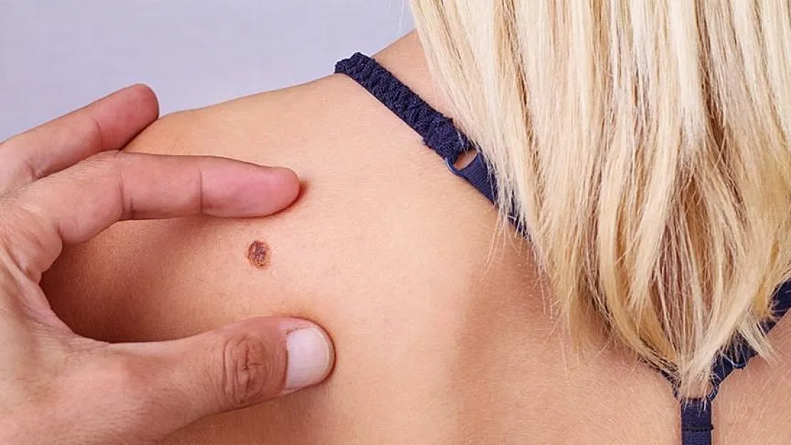 Cilt Kanseri (Melanom Dışı) Belirtileri Nelerdir?