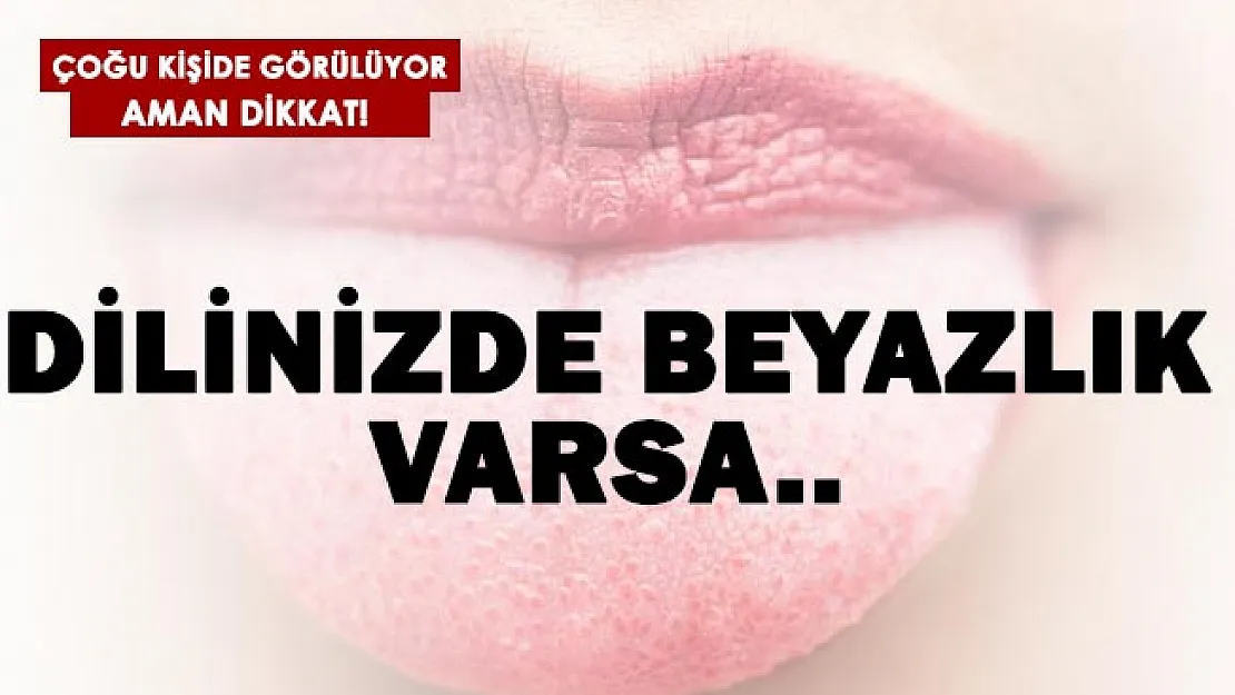Dilinizde beyazlık varsa buna çok dikkat edin!