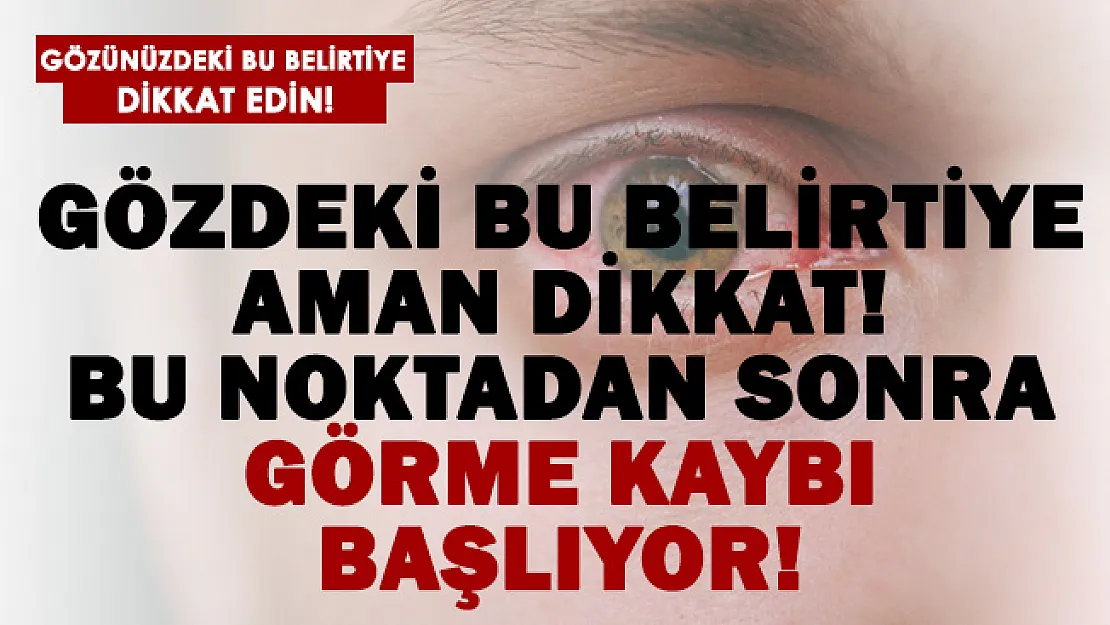 Gözünüze dikkat! Bu belirti sonrasında görme kaybı yaşanabilir!