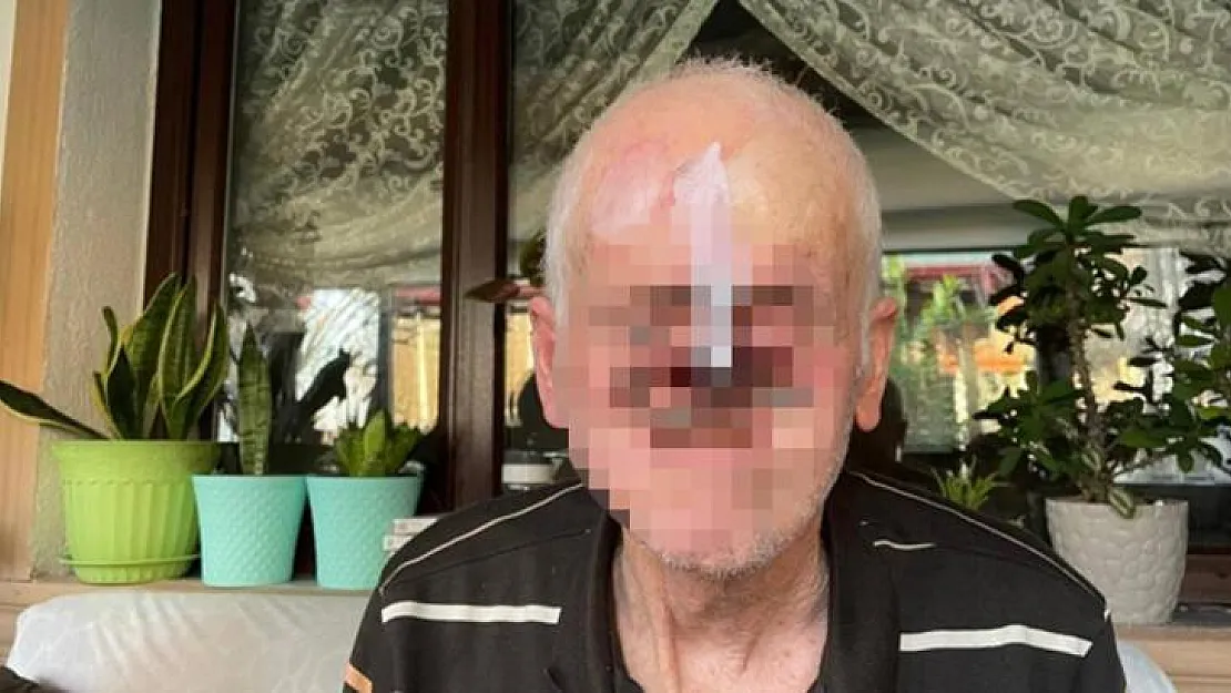 Her şey bir sivilceyle başladı! Zamanla burnu eridi!