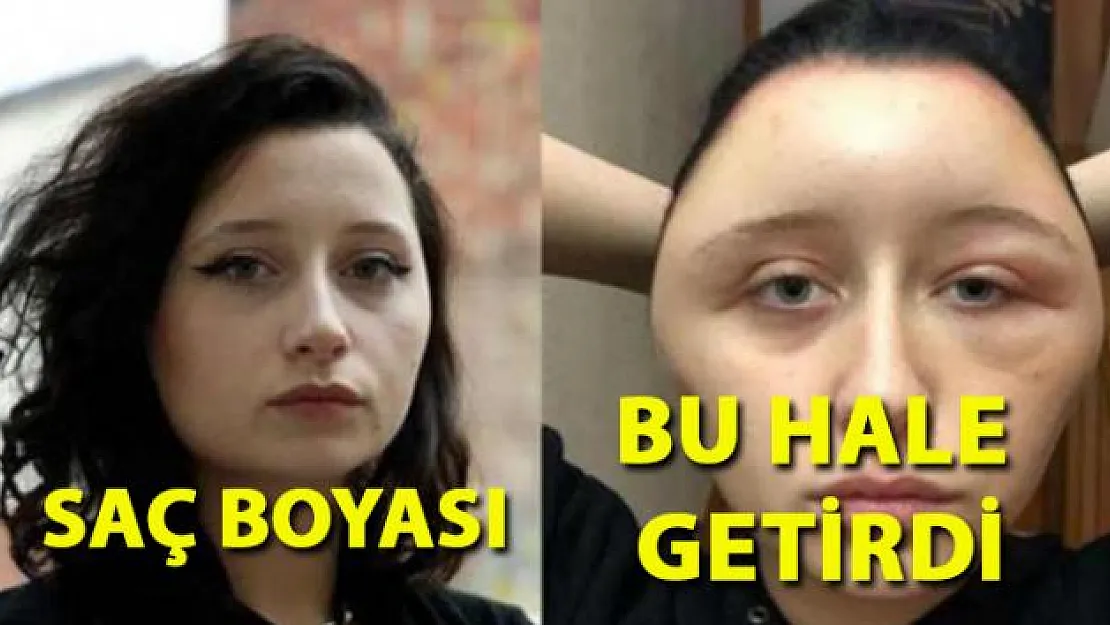Saç boyası kullanmadan önce alerji testi yaptırmanın önemi