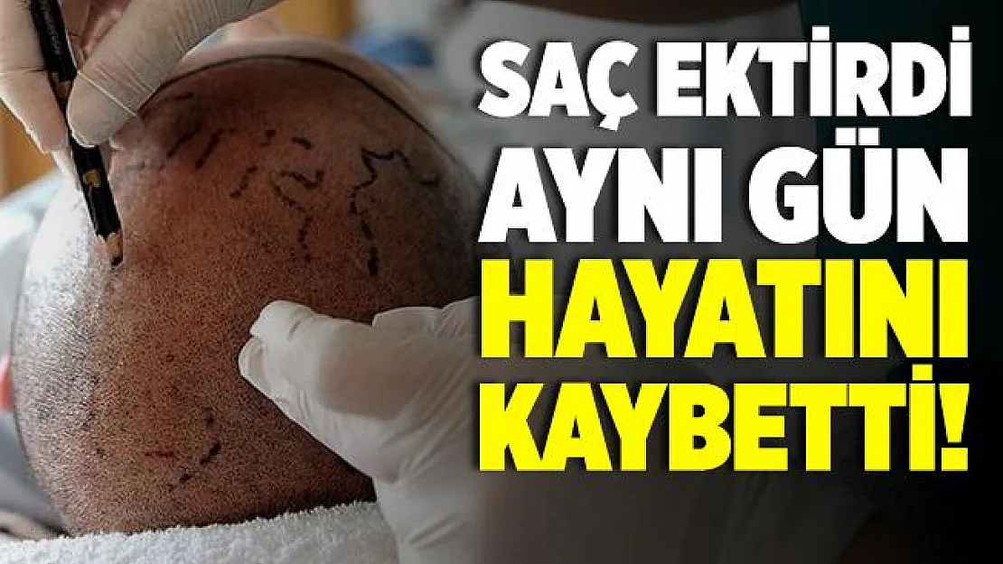 Saç ekimi yaptırdı, hayatını kaybetti! Saç ekimi yan etkileri nedir?