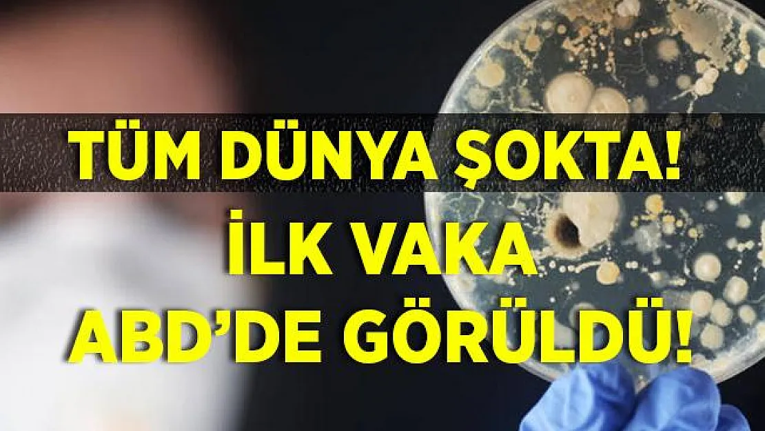Tüm dünya şokta! ABD'de beyin yiyen amip vakası görüldü! Beyin yiyen amip nedir?