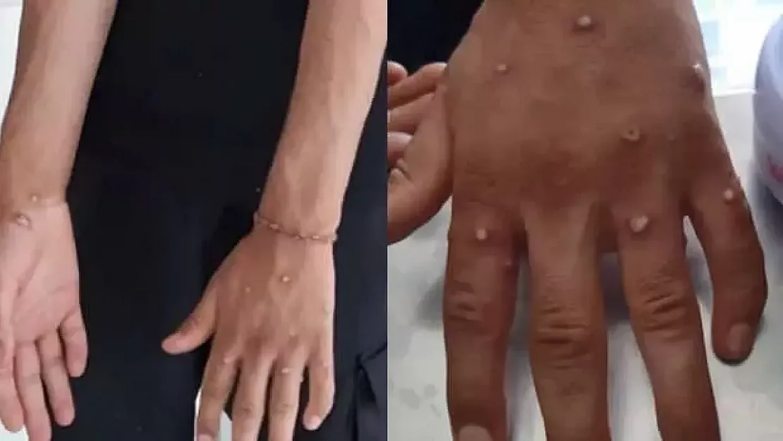 Türkiye'de Maymun Çiçeği Alarmı!