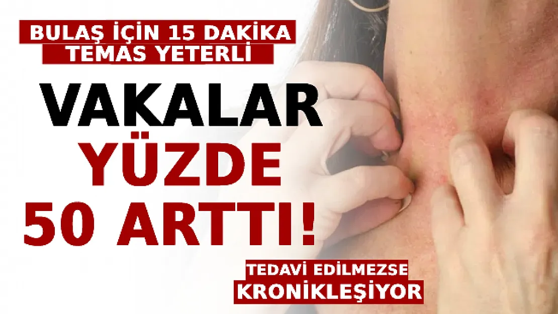Vakalar Yüzde 50 Arttı! Bulaş İçin 15 Dakika Temas Yeterli! Tedavi Edilmezse Kronikleşiyor