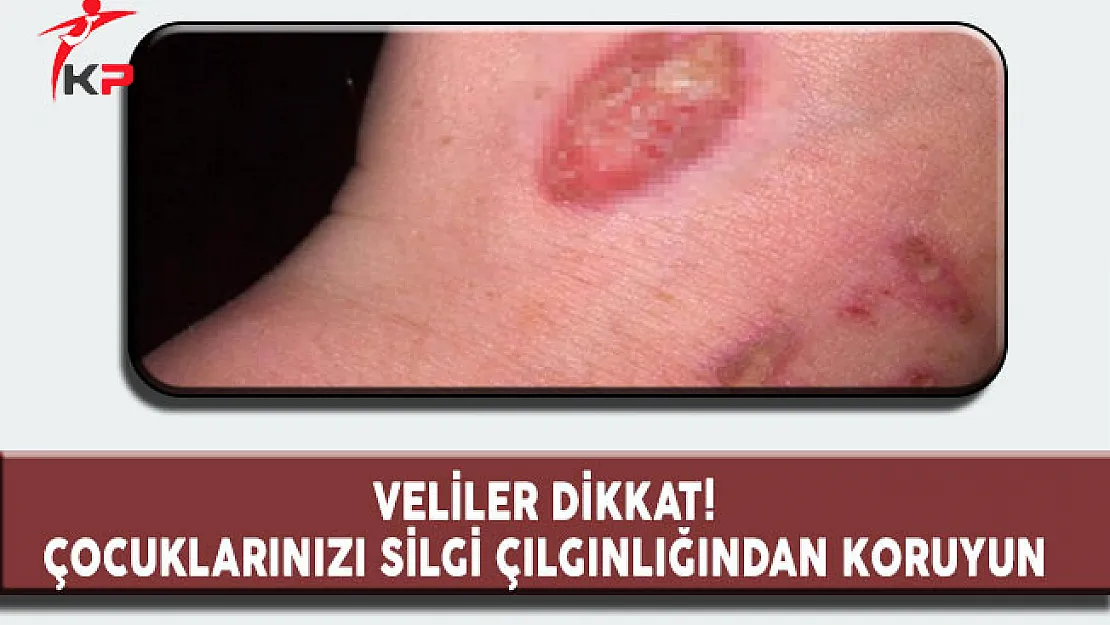 Veliler Dikkat! Çocuklarınızı Silgi Çılgınlığından Koruyun