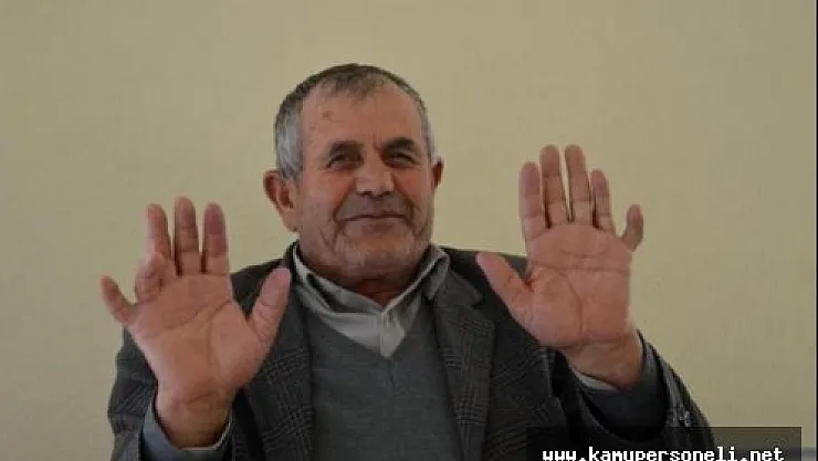 24 Parmağı Olan Ali İhsan Özdemir Görenleri Şaşırtıyor