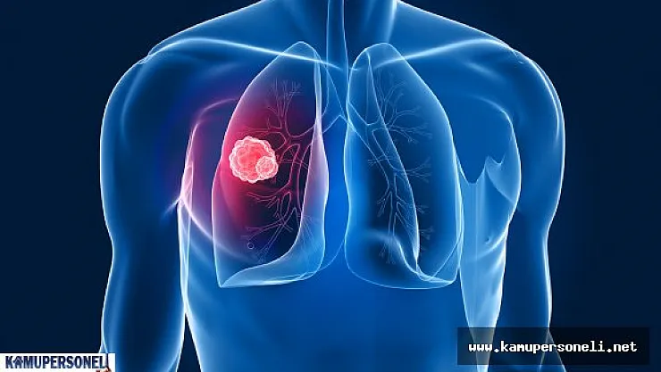 Akciğer Kanseri Nedir, Nasıl Tedavi Edilir?