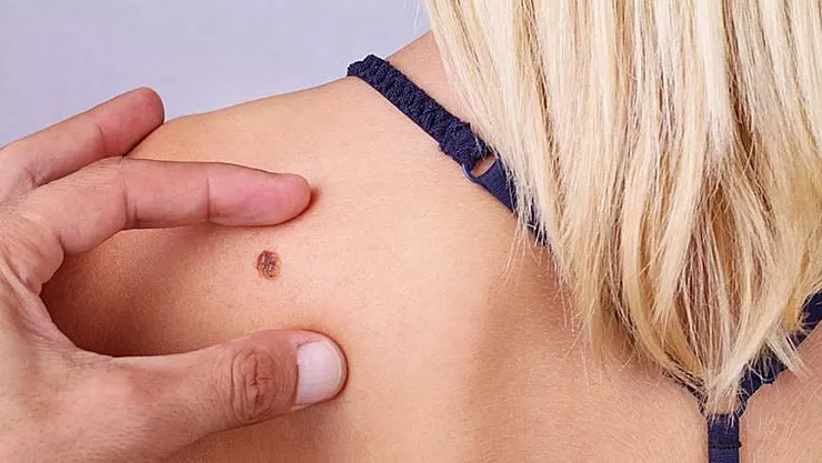 Cilt Kanseri (Melanom Dışı) Belirtileri Nelerdir?