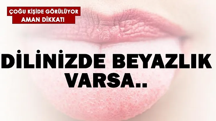 Dilinizde beyazlık varsa buna çok dikkat edin!