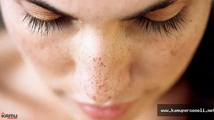 Doğal Yöntemler ile Cilt Lekelerine Kesin Çözüm
