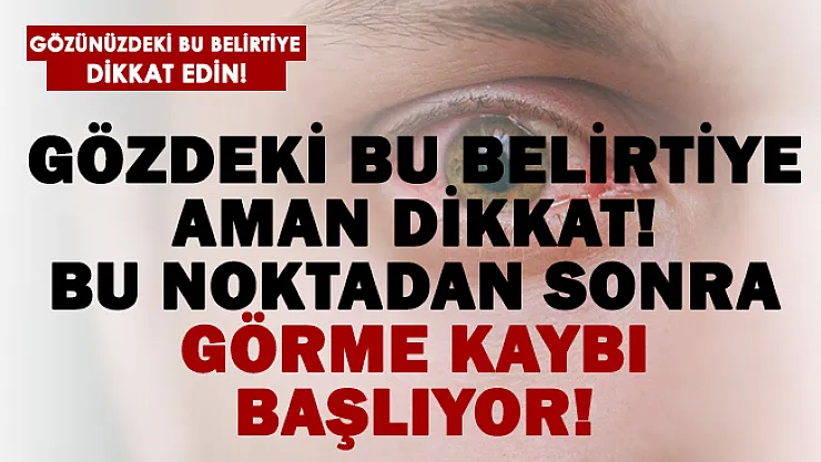 Gözünüze dikkat! Bu belirti sonrasında görme kaybı yaşanabilir!