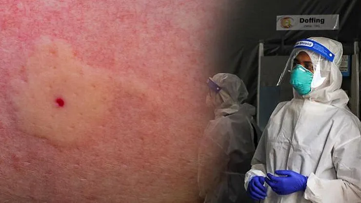 Koronavirüs atlatan özellikle kadınlara kötü haber!