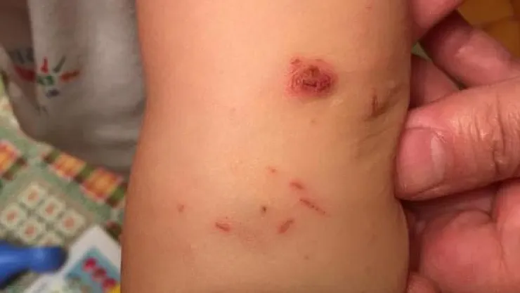 O ilde uyuz vakaları arttı : Sağlık müdürlüğü uyarı yayımladı!