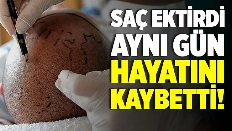 Saç ekimi yaptırdı, hayatını kaybetti! Saç ekimi yan etkileri nedir?