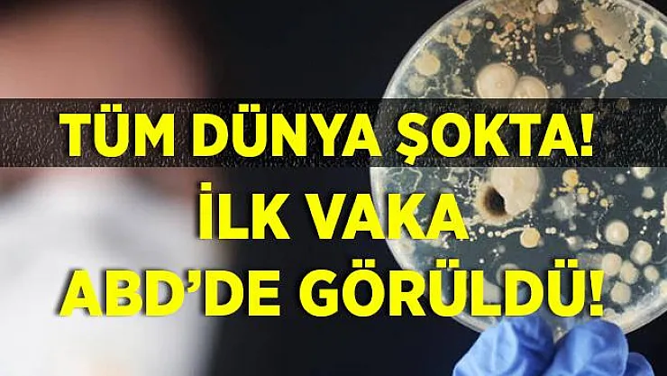 Tüm dünya şokta! ABD'de beyin yiyen amip vakası görüldü! Beyin yiyen amip nedir?