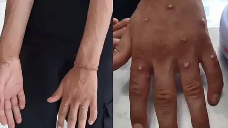 Türkiye'de Maymun Çiçeği Alarmı!